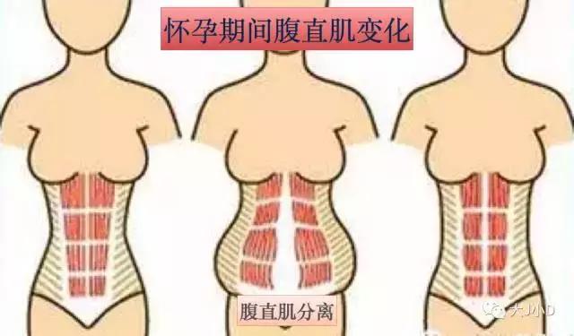 你的腹直肌分離了嗎？
