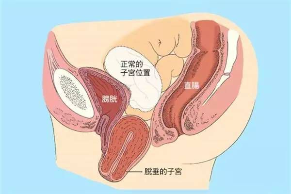 【產(chǎn)后修復(fù)】盆腔臟器脫垂，你有嗎？