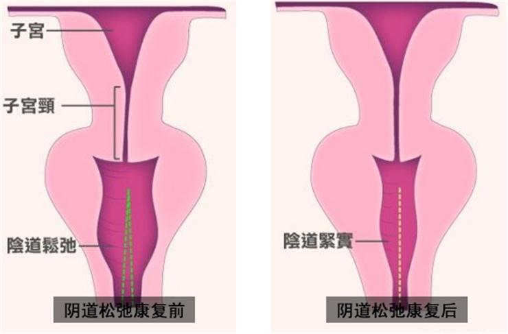 【盆底肌修復(fù)】盆底不修復(fù)，老來后患無窮