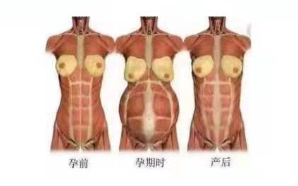 小巧便攜式產(chǎn)后康復(fù)治療儀，跟腹直肌分離說(shuō)拜拜