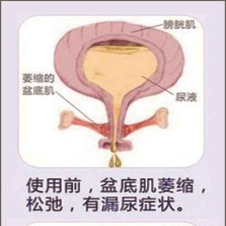產(chǎn)后盆底肌康復|“社交癌”盯上你了嗎？