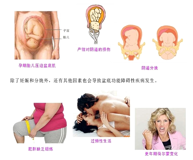 產(chǎn)后康復(fù)治療很重要，慢性盆腔痛很重要