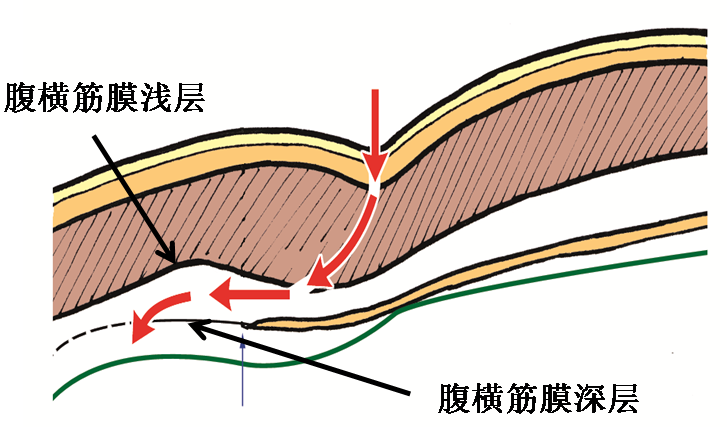 產(chǎn)后腹直肌分離如何康復(fù)，腹直肌修復(fù)那點(diǎn)事