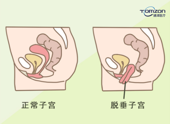 你害怕子宮脫垂嗎？盆底肌修復儀器來拯救你